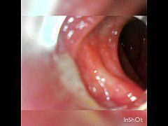 Geneva reccomend mouth endoscope