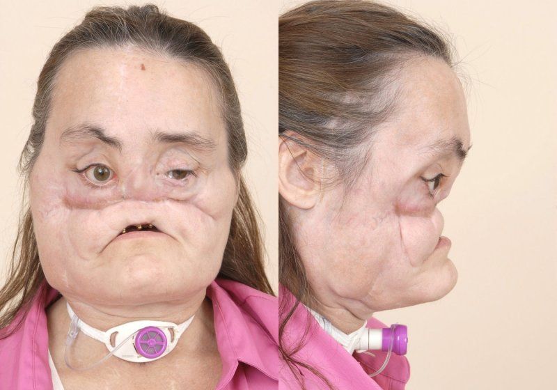 Butcher B. recommendet Facial allograft transplantation