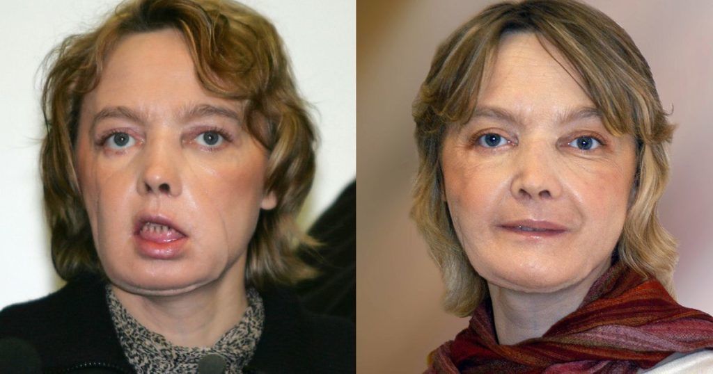 best of Allograft transplantation Facial