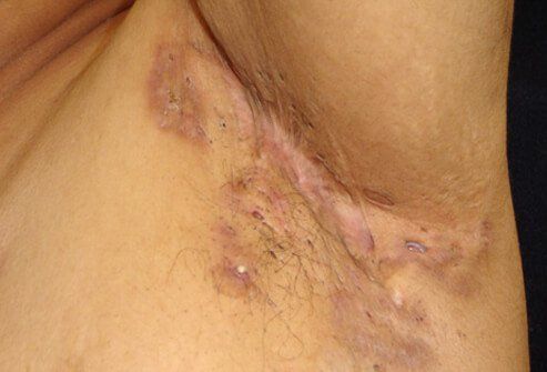 Infected hair follicle near the anus
