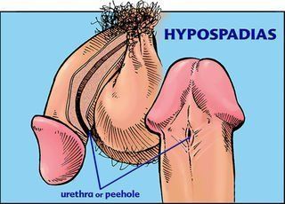 best of Effecting sperm delivery Hypospadias