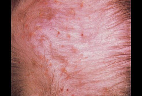 best of Near the hair follicle anus Infected