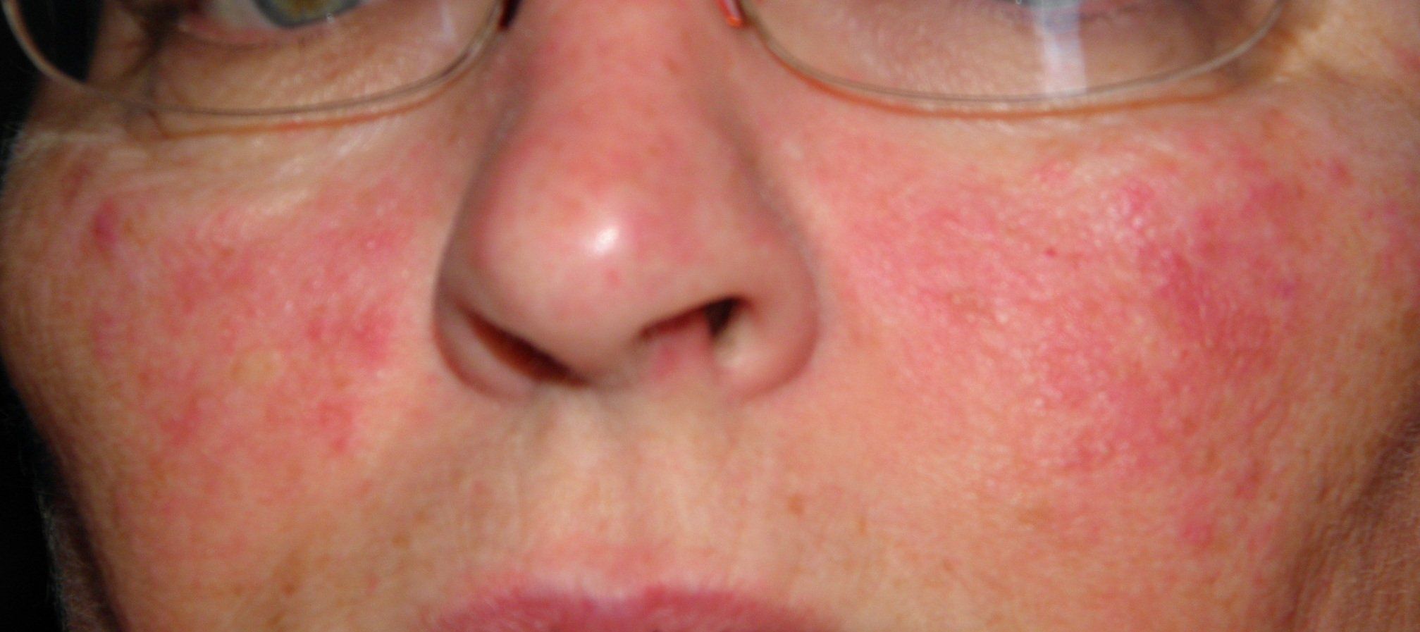 Facial rash cheeks