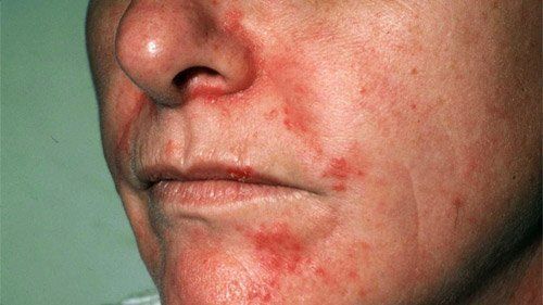 Vicious reccomend Treatments for facial eczema